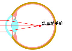 近視眼の状態